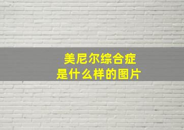 美尼尔综合症是什么样的图片